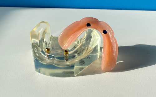 Implant Supported Dentures