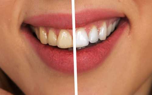 Whitening